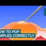 Popping Blackheads