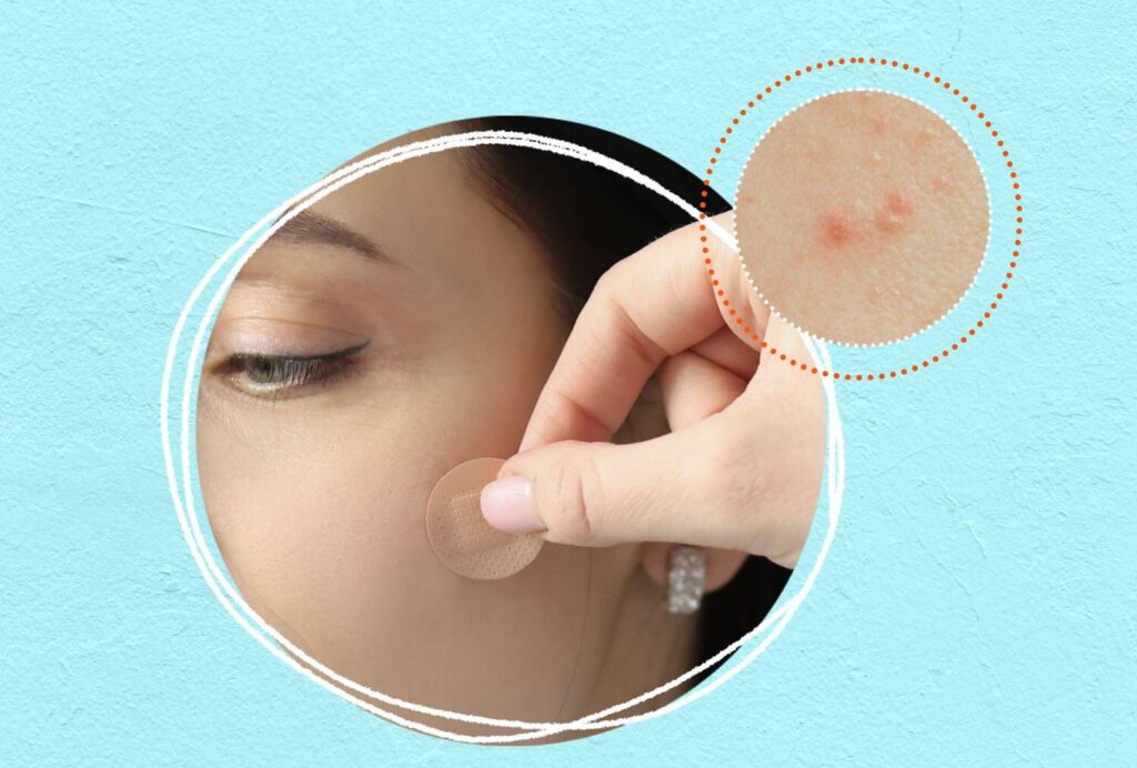  Pimple Patches